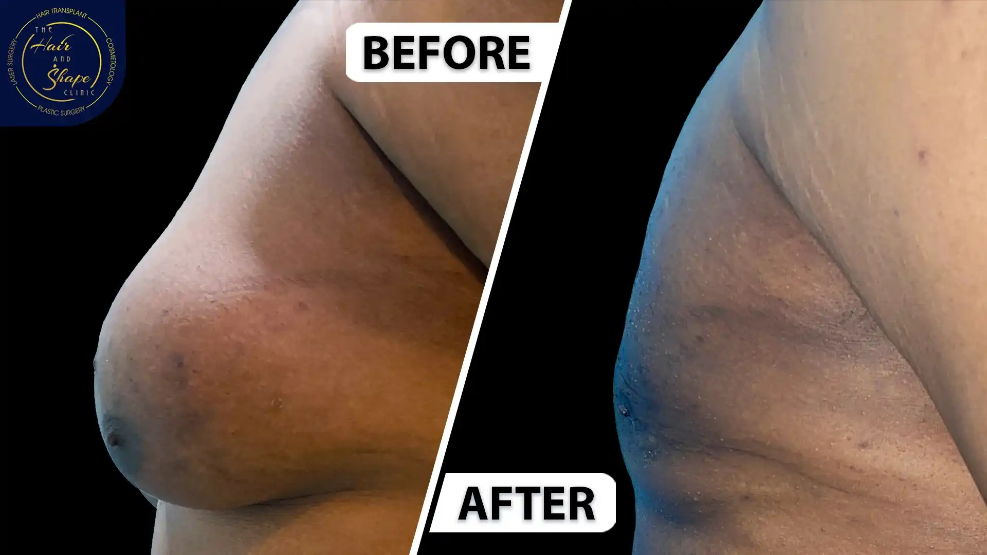 Gynecomastia result3